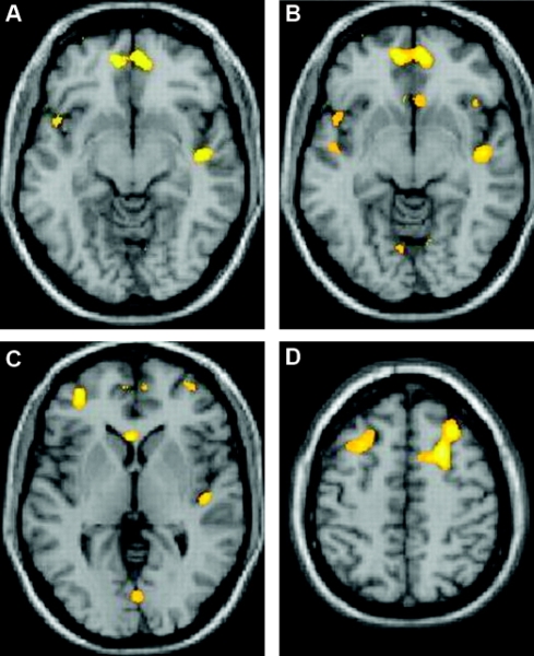 Life in the thrall of migraine